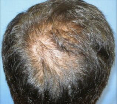 Alopecia Before Treatment